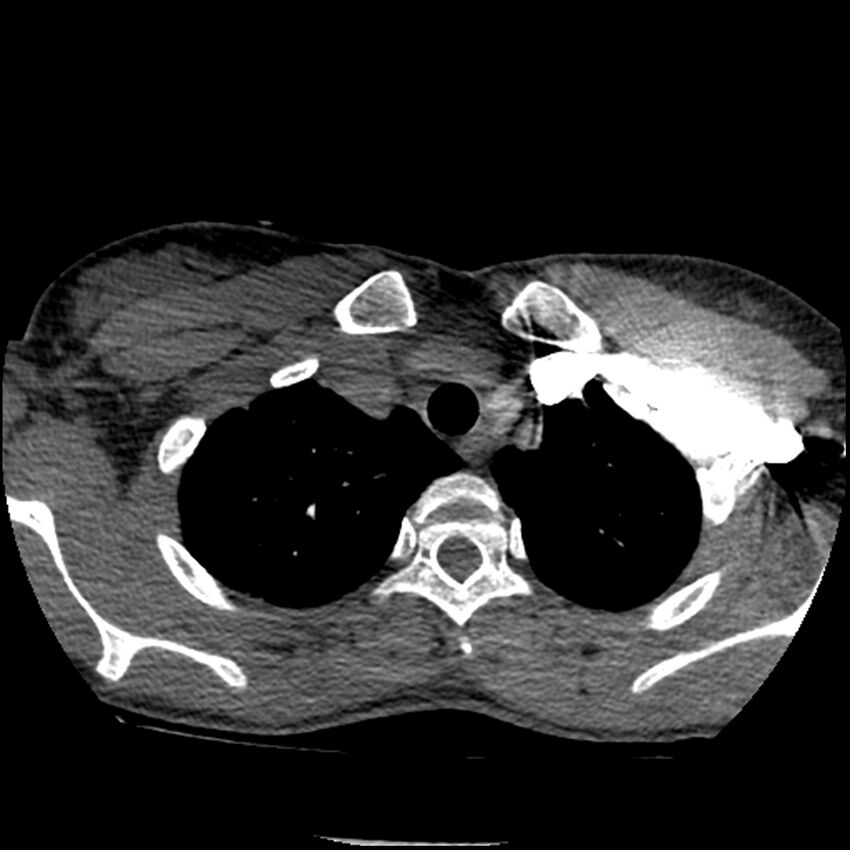 Acute chest syndrome - sickle cell disease (Radiopaedia 42375-45499 Axial C+ CTPA 33).jpg