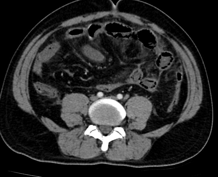 File:Acute mesenteric ischemia - superior mesenteric artery thrombosis (Radiopaedia 73947-84776 Axial C+ arterial phase 99).jpg