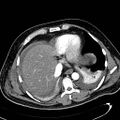 Acute pancreatic necrosis (Radiopaedia 13560-13486 Axial C+ portal venous phase 20).jpg