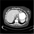 Acute pancreatitis (Radiopaedia 19136-19117 Axial C+ portal venous phase 3).jpg