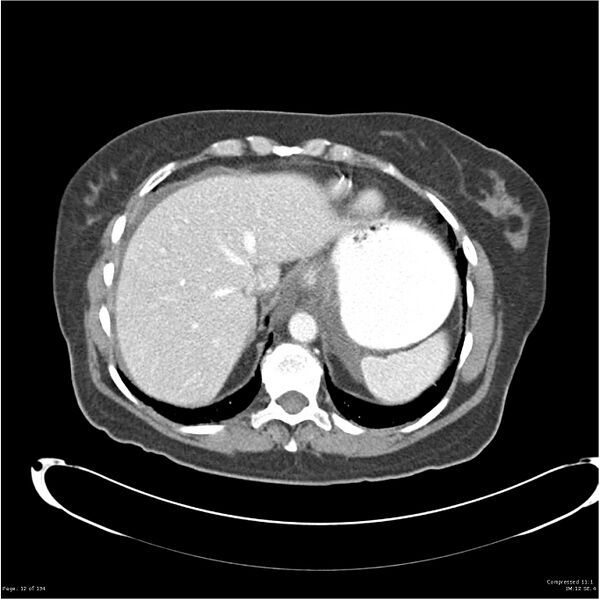 File:Acute pancreatitis (Radiopaedia 19136-19117 Axial C+ portal venous phase 3).jpg