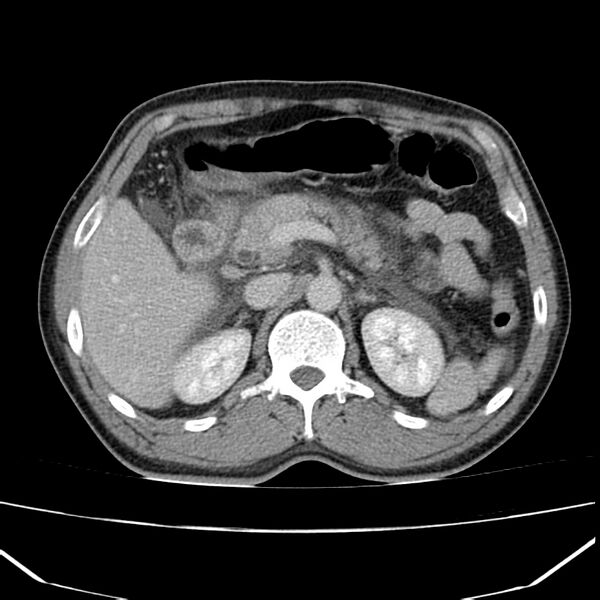 File:Acute pancreatitis (Radiopaedia 22572-22596 Axial C+ portal venous phase 24).jpg