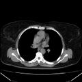 Acute pancreatitis - Balthazar C (Radiopaedia 26569-26714 Axial non-contrast 1).jpg