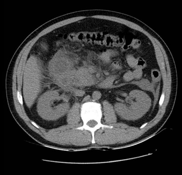File:Acute pancreatitis - Balthazar E (Radiopaedia 23080-23110 Axial non-contrast 29).jpg