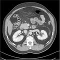 Acute pancreatitis - mild (Radiopaedia 27796-28033 C+ portal venous phase 16).jpg