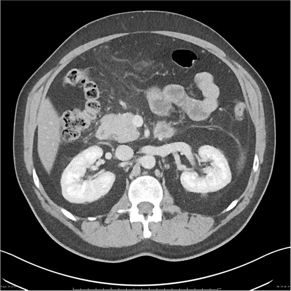 File:Acute pancreatitis - mild (Radiopaedia 27796-28033 C+ portal venous phase 16).jpg