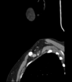 Acute parotitis (Radiopaedia 27425-27619 Sagittal C+ portal venous phase 3).png