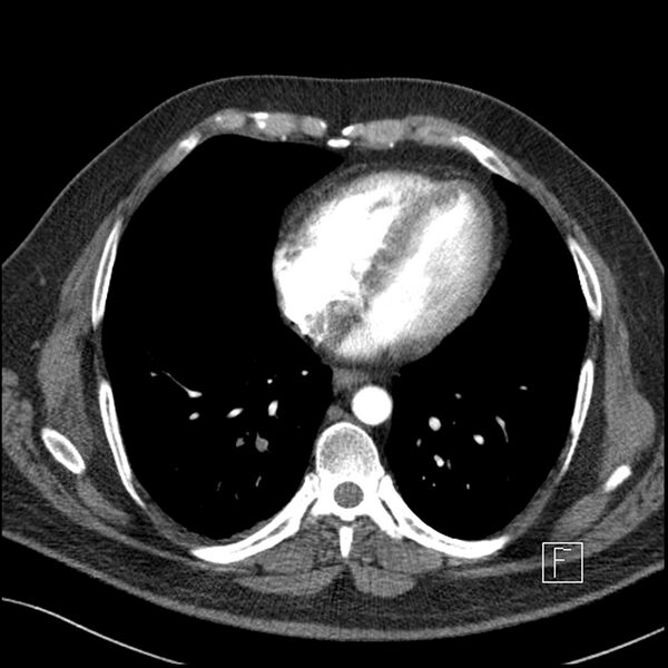 File:Acute pulmonary embolism with pulmonary infarct (Radiopaedia 73062-83768 Axial C+ CTPA 52).jpg