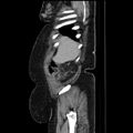Acute pyelonephritis (Radiopaedia 25657-25837 Sagittal renal parenchymal phase 18).jpg