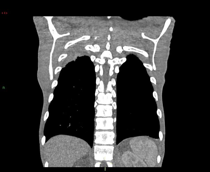 File:Acute right lung abscess (Radiopaedia 34806-36258 Coronal C+ arterial phase 7).jpg