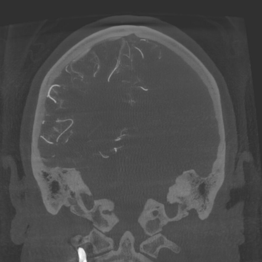 Acute subarachnoid hemorrhage and accessory anterior cerebral artery (Radiopaedia 69231-79010 Coronal arterial - MIP 68).jpg