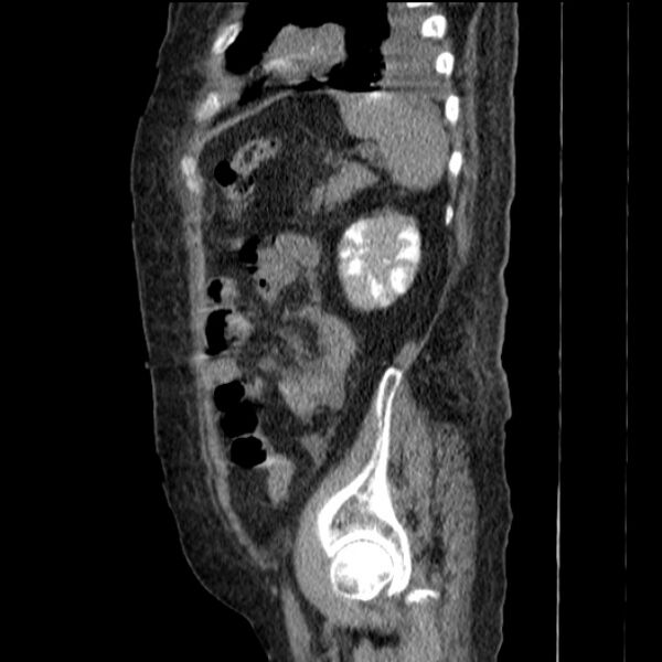 File:Acute tubular necrosis (Radiopaedia 28077-28334 H 68).jpg