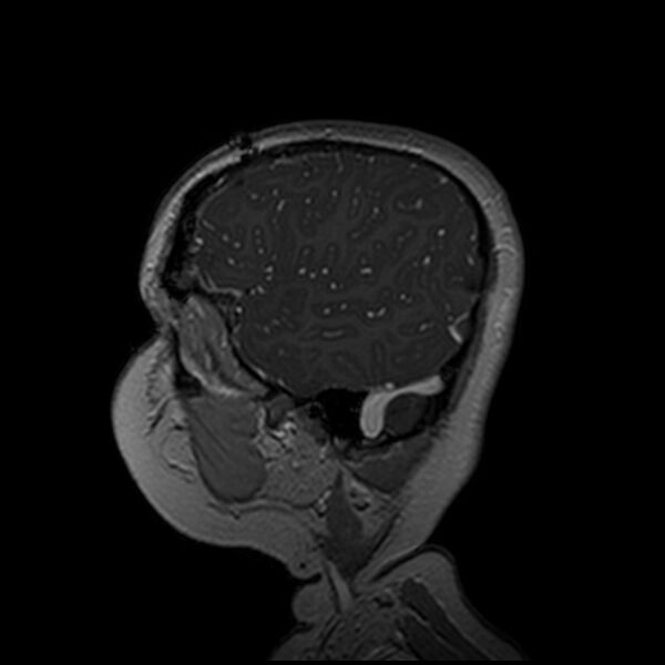 File:Adamantinomatous craniopharyngioma (Radiopaedia 77407-89529 H 102).jpg