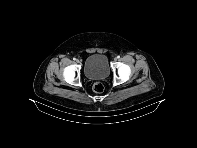 File:Adenocarcinoma of pancreas with hepatic metastasis (Radiopaedia 64332-73122 Axial C+ portal venous phase 94).jpg
