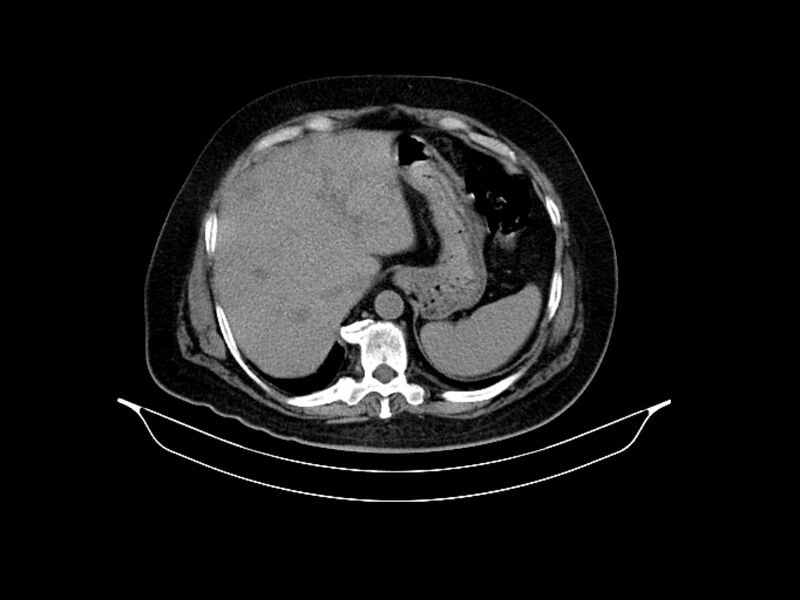 File:Adenocarcinoma of pancreas with hepatic metastasis (Radiopaedia 64332-73122 Axial non-contrast 22).jpg