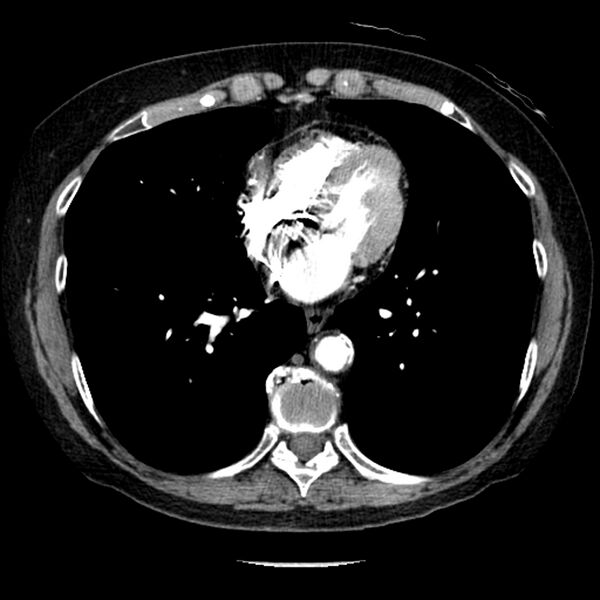 File:Adenocarcinoma of the lung (Radiopaedia 41015-43755 Axial C+ portal venous phase 79).jpg