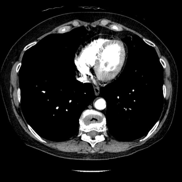 File:Adenocarcinoma of the lung (Radiopaedia 41015-43755 Axial C+ portal venous phase 88).jpg