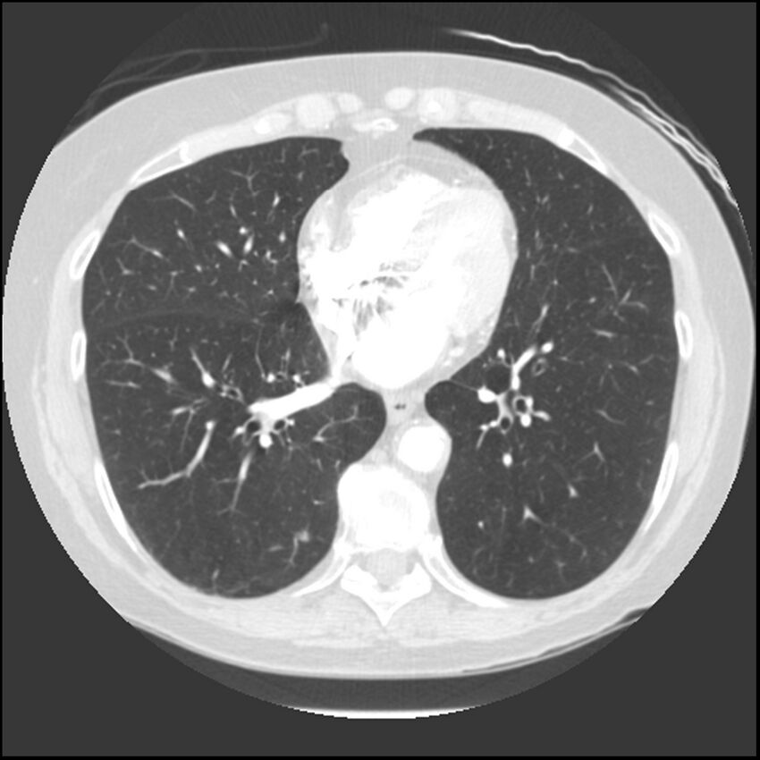 Adenocarcinoma of the lung (Radiopaedia 41015-43755 Axial lung window 78).jpg