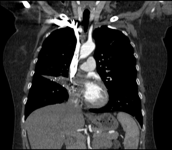 File:Adenocarcinoma of the lung (Radiopaedia 44205-47803 Coronal C+ portal venous phase 37).jpg