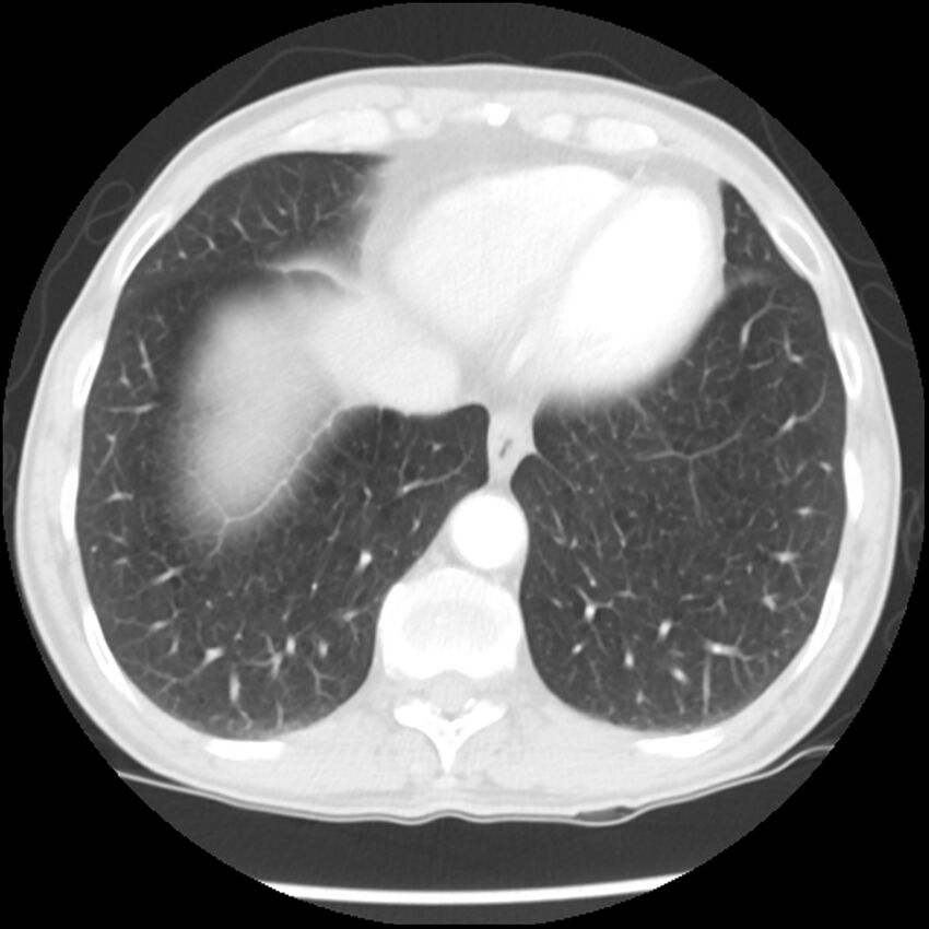 Adenocarcinoma of the lung - micropapillary predominant (Radiopaedia 42446-45563 Axial lung window 59).jpg