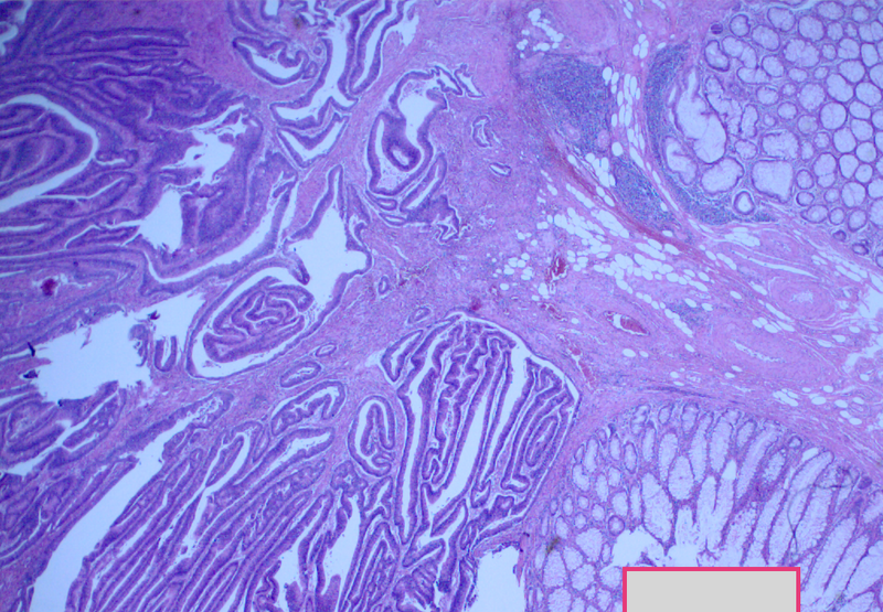 File:Adenocarcioma of rectum- T1 lesion (Radiopaedia 36921-38552 A 1).PNG