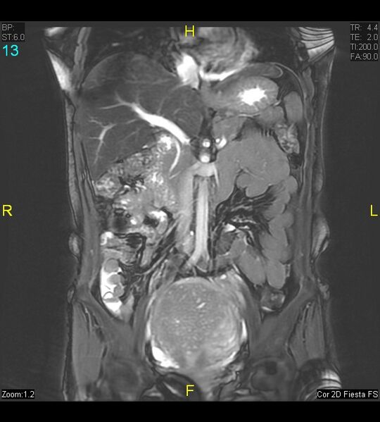 File:Adenomyosis (Radiopaedia 43504-46889 Coronal 2D FIESTA 13).jpg