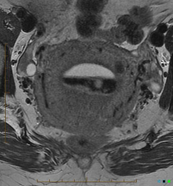 File:Adenomyosis uterus with hematometra (Radiopaedia 45779-50011 Axial T2 17).jpg