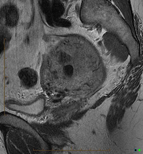 File:Adenomyosis uterus with hematometra (Radiopaedia 45779-50011 Sagittal T2 22).jpg