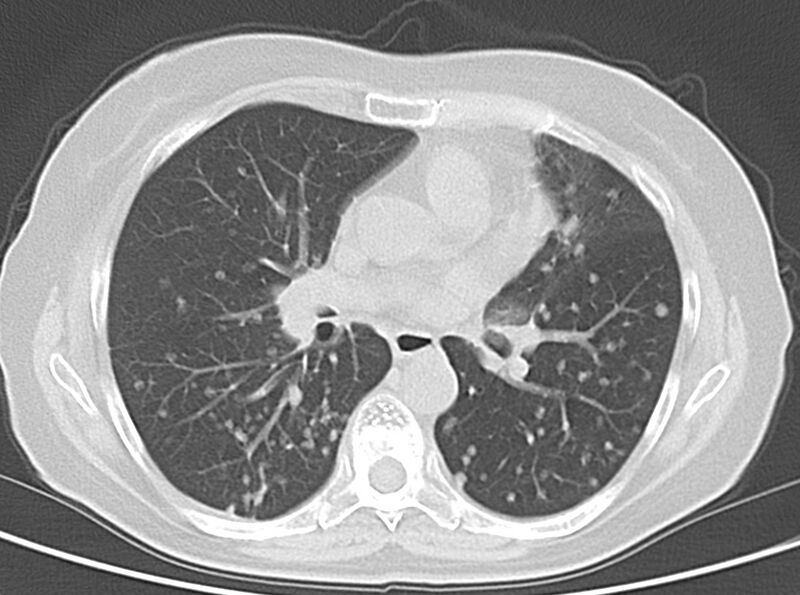 File:Adenosquamous lung carcinoma (Radiopaedia 22035-22030 lung window 33).jpg