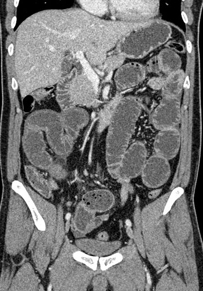 File:Adhesional small bowel obstruction (Radiopaedia 58900-66131 Coronal C+ portal venous phase 127).jpg