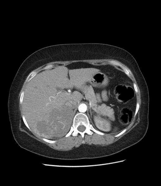 File:Adrenal cortical carcinoma with IVC invasion and thrombosis (Radiopaedia 34307-35597 Axial C+ arterial phase 23).jpg