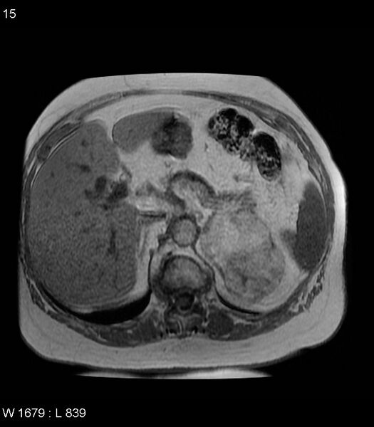 File:Adrenal myelolipoma (Radiopaedia 6765-7961 Axial T1 in-phase 15).jpg