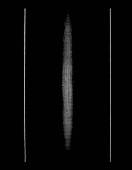 File:Adrenal myelolipoma - bilateral (Radiopaedia 74805-85810 Coronal C+ portal venous phase 4).jpg