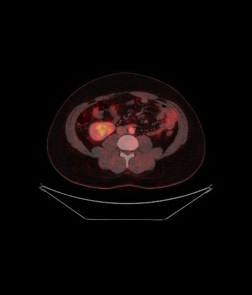 File:Adrenocortical carcinoma (Radiopaedia 80134-93440 ِAxial 193).jpg