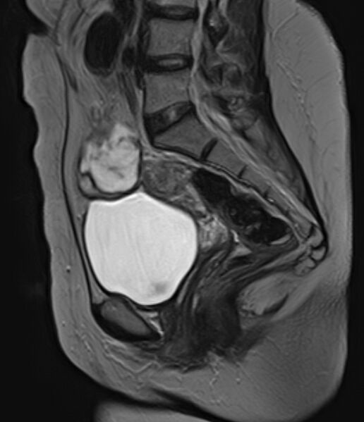 File:Adult granulosa cell tumor of the ovary (Radiopaedia 71581-81950 Sagittal T2 11).jpg