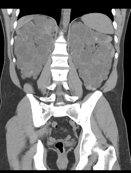 File:Adult polycystic kidney disease (Radiopaedia 47866-52626 Coronal non-contrast 34).png