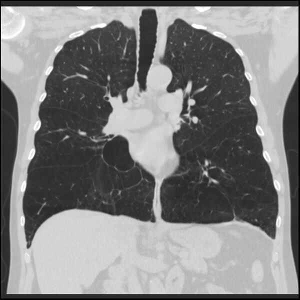 File:Alpha-1-antitrypsin deficiency (Radiopaedia 40993-43722 Coronal lung window 50).jpg