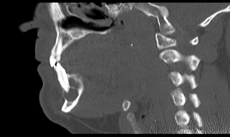 File:Ameloblastoma (Radiopaedia 33677-34806 Sagittal bone window 29).png