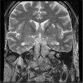 Amnestic syndrome secondary to hypoxic brain injury (Radiopaedia 24743-25004 F 11).jpg