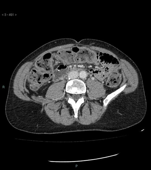 File:Ampulla of Vater metastasis (Radiopaedia 27820-28069 A 129).jpg