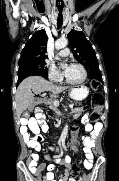 File:Ampullary adenocarcinoma (Radiopaedia 86093-102033 D 24).jpg