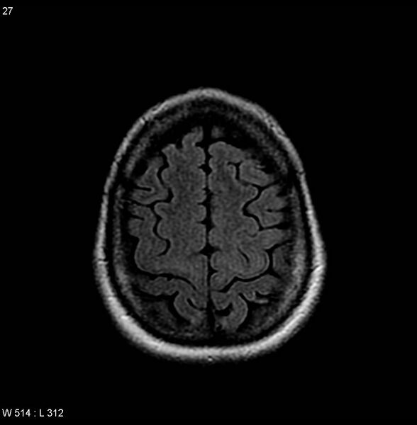 File:Amyotrophic lateral sclerosis (Radiopaedia 4719-6744 Axial FLAIR 9).jpg