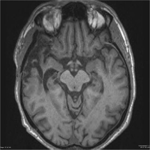 File:Anaplastic meningioma with recurrence (Radiopaedia 34452-35788 Axial T1 55).jpg