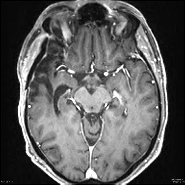 File:Anaplastic meningioma with recurrence (Radiopaedia 34452-35788 Axial T1 C+ 60).jpg