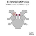 Anderson and Montesano classification of occipital condyle fractures (diagrams) (Radiopaedia 87203-103478 type 1 1).jpeg