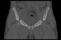 Aneurysmal bone cyst of ischium (Radiopaedia 25957-26094 Coronal bone window 12).png