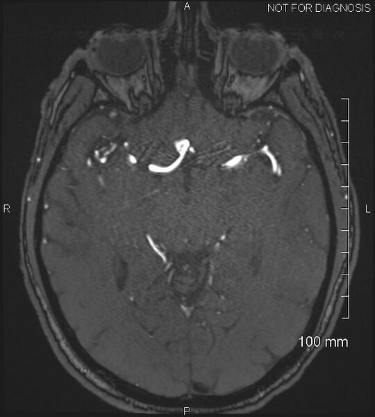 File:Anterior cerebral artery aneurysm (Radiopaedia 80683-94127 Axial MRA 106).jpg