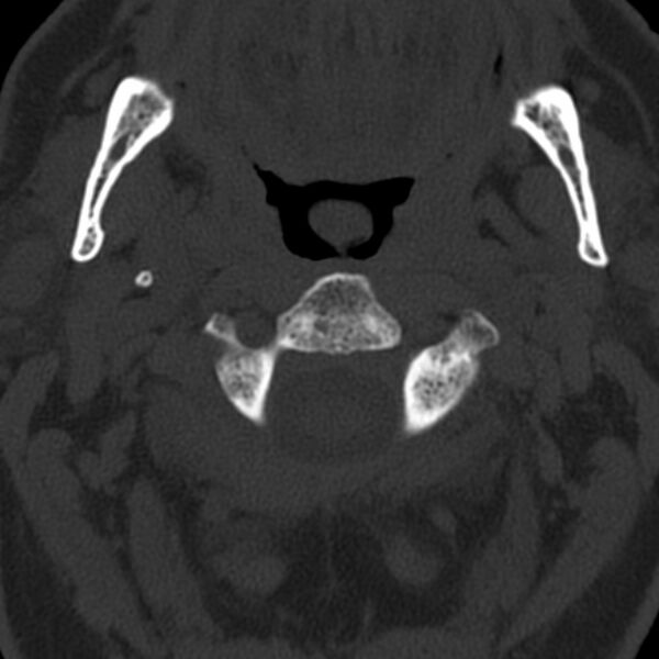 File:Anterior cervical postdiscectomy arthrodesis (Radiopaedia 32678-33646 Axial bone window 20).jpg