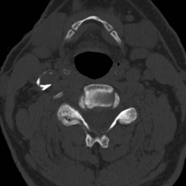 File:Anterior cervical postdiscectomy arthrodesis (Radiopaedia 32678-33646 Axial bone window 39).jpg