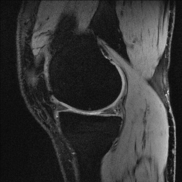 File:Anterior cruciate ligament mucoid degeneration (Radiopaedia 68400-77933 Sagittal 47).jpg